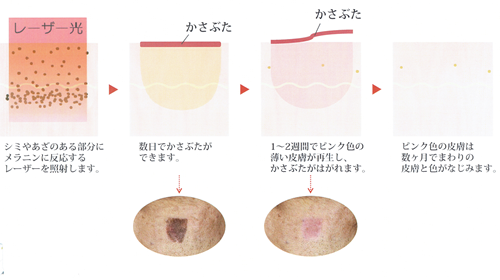 レーザー治療の仕組み